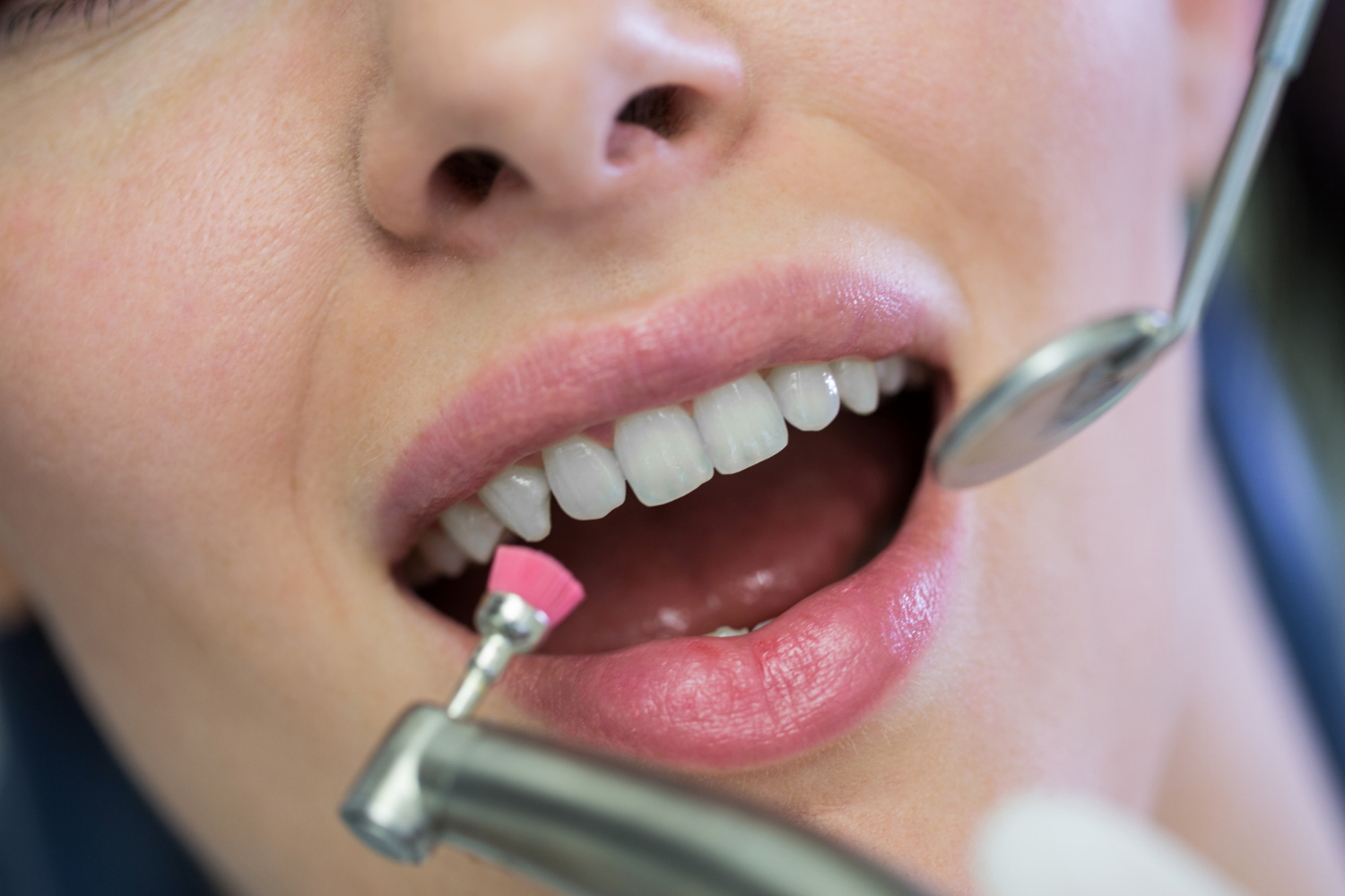 Teeth Cleaning​