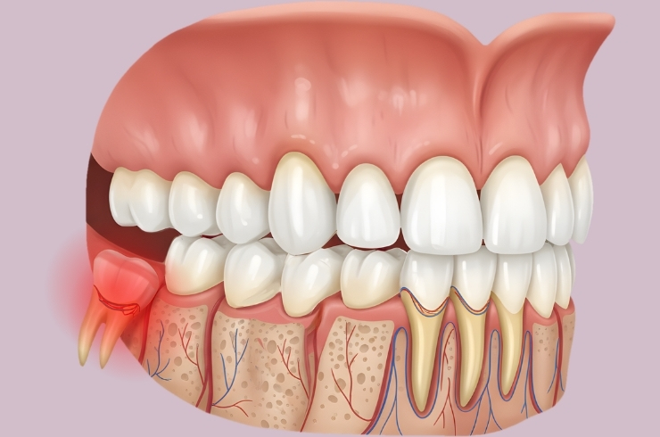Wisdom Teeth Removal