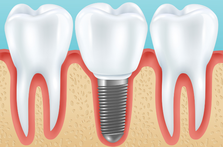 Dental Implants